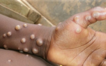 EU donates 215,000 Mpox vaccine doses to Africa
