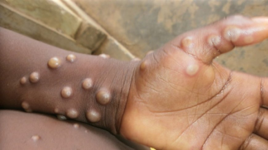 EU donates 215,000 Mpox vaccine doses to Africa