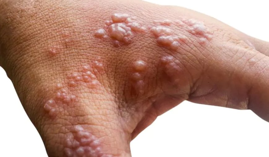 Mpox may affect Nigerian, African economies – Fitch