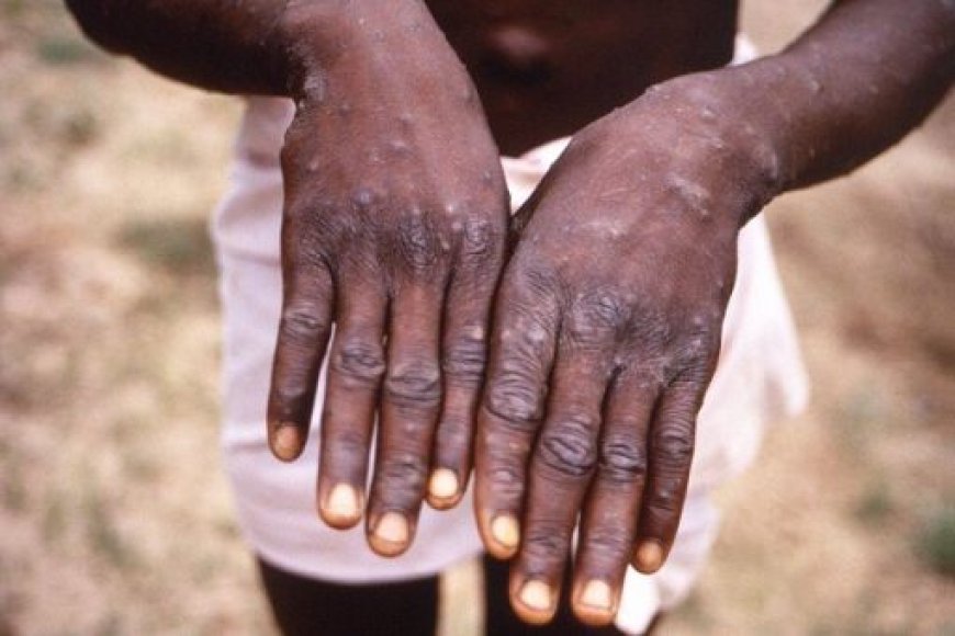 Nigeria records eight cases of Mpox as outbreak spreads to 35 LGs, 19 States, FCT