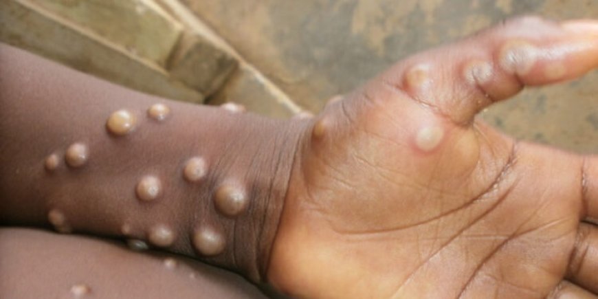 NCDC confirms 55 cases of monkeypox across 21 states