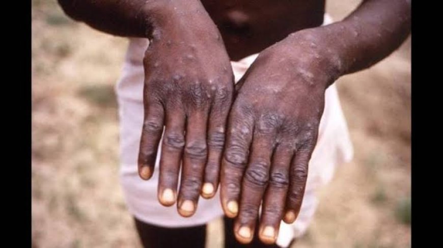 Mpox: Expert Warns Against Bush Meat Consumption